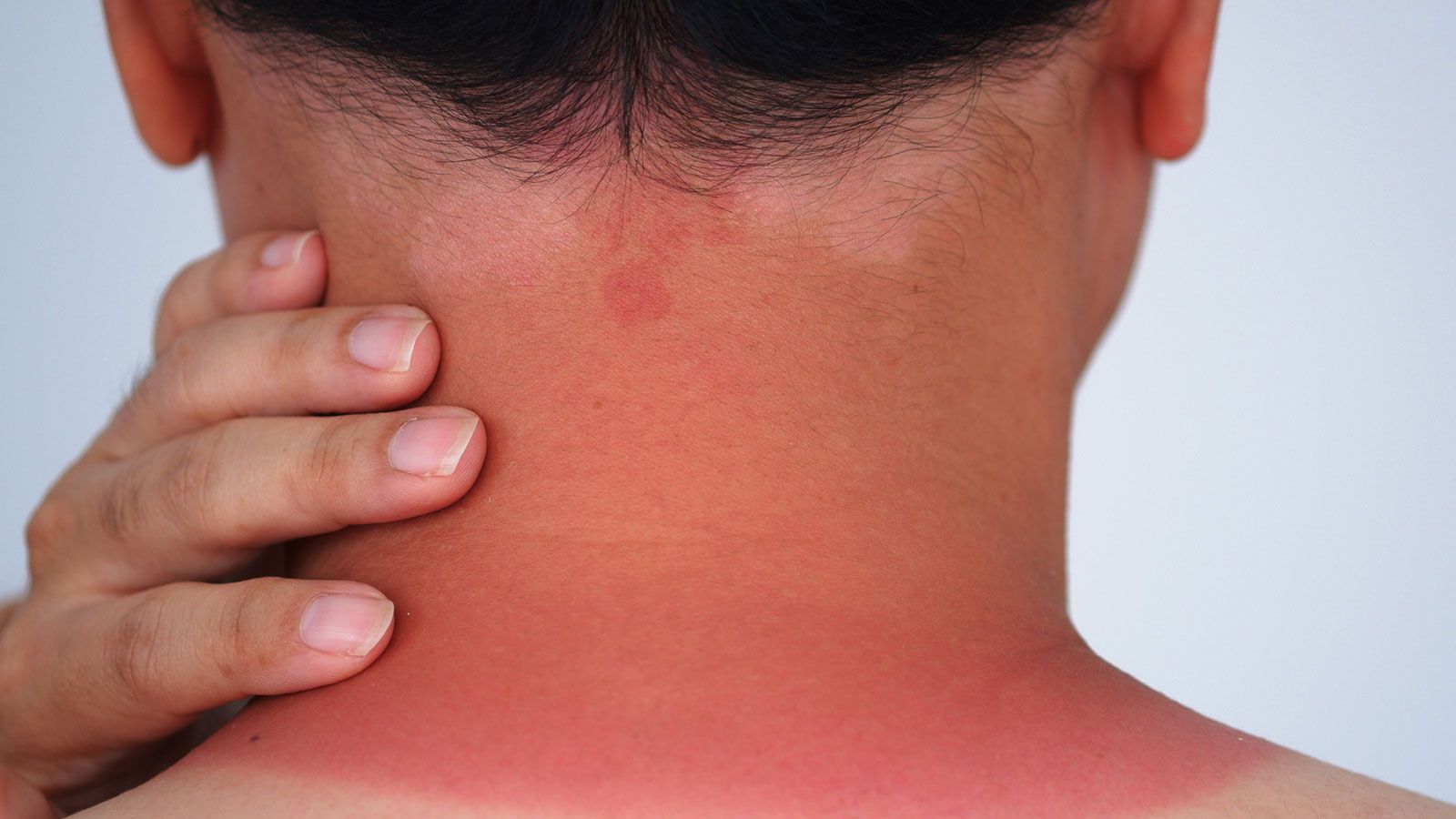 Hinterkopf und Nacken mit deutlich sichtbarem Sonnenbrand und einer Hand, die den Nacken berührt